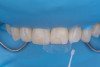 (21.) Intraoral view after rubber dam isolation, showing prepared surfaces: both sandblasted and etched, with silanization applied only to the composite surface, ready for reattachment.