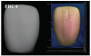 <strong>(4.) </strong>Printed
crown in the 0-degree orientation using 5YSZ resin after sintering (left), and
3D measurement microscope scan of the surface of the printed crown showing
stair-step print lines (right).</p>