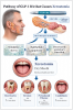 <strong>(2.) </strong>Proposed Pathway of Incretin
Medication-Associated Xerostomia and Oral Sequelae. This figure illustrates the
proposed mechanism by which GLP-1ra and/or GIPR medications may contribute to
xerostomia and downstream oral complications. Following systemic administration,
GLP-1 receptor activation in salivary gland tissue is associated with oxidative
stress, epithelial cellular dysfunction, and reduced secretory activity,
leading to decreased salivary flow. The resulting hyposalivation compromises
buffering capacity and antimicrobial defense, increasing the risk of root
caries, dental erosion, periodontal inflammation, and oral candidiasis. (Image
created with CoPilot AI)