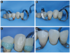 (2.) Clinical case of post-radiation cervical caries management. The patient was diagnosed with HPV-related sinonasal carcinoma and treated with induction chemotherapy (carboplatin and paclitaxel), followed by concurrent chemoradiotherapy with cisplatin (2 cycles). Radiotherapy was completed in December 2023, with a total dose of 69.96 Gy delivered in 33 fractions. Restorative treatment was performed approximately two years post-radiotherapy. (A) Initial clinical presentation of radiation-related cervical caries on teeth Nos. 26 and 28, extending toward the root surfaces. Rubber dam isolation facilitates visualization of the full extent of the lesions. (B) Cavity preparations on teeth Nos. 26 and 28 following complete removal of carious tissue. (C) Selective enamel etching prior to the application of a self-etch adhesive system. (D) Final aspect of the completed resin composite restorations on teeth Nos. 26 and 2
