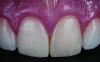 Figure 1 Preoperative, preparation, and final postoperative images of a 2-unit CL-I feldspathic veneer case.