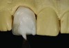 Figure 4 Hand layering with a brush a CL-I feldspathic ceramic.