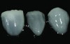 Figure 7 CL-IIa veneers with minimal incisal porcelain layering.