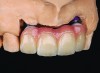 Figure 13 Image of a porcelain-layered zirconia framework (CL-IIIb) with layered pink porcelain for the gingiva (image courtesy of Aram Torosian, MDC).