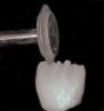 Figure 2 A contoured diamond wheel can be used to shape mamelons on a hot-pressed leucite-reinforced ceramic crown.