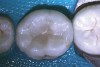 (6.) Restoration of tooth No. 19.