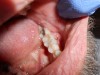 Clinical confirmation of the periradicular diagnosis—chronic apical abscess on tooth No. 19. The tooth is not sensitive to percussion or palpation. A gutta-percha #25/.04 cone is inserted into the sinus tract.