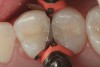 2. Side-by-side restorations placed with bulk-fill composite (Aura Bulk Fill, SDI) prior to removal of the sectional matrix on the distal aspect of tooth No. 12. A sectional matrix was first placed on the mesial aspect of tooth No. 13 and the restorative material placed and contoured prior to filling the preparation on tooth No. 12.