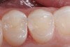12. An occlusal view of the completed distal occlusal composite restoration on tooth No. 5.