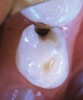 Application of silver diamine fluoride on distal of primary first molar. Silver diamine fluoride is also able to treat smaller lesion on mesial of second primary molar.