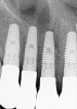 (24.) Radiograph of postoperative individual crowns on Nos. 6 through 10.