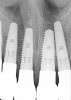 (25.) Radiograph of postoperative individual crowns on Nos. 6 through 10.