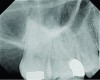(4. AND 5.) This maxillary first molar was to have endodontic therapy following diagnosis of irreversible pulpitis.