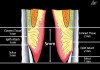 Figure 5  Variations in biologic width can occur in the low-crest patient. Left. An average biologic width of 2 mm, with a connective tissue attachment of 1 mm and an epithelial attachment of 1 mm. The total height of gingiva above bone is 5 mm, with a 3-mm sulcus. This is a patient in whom recession might be likely following any restorative procedure. Right. A variation on normal biologic width in the low-crest patient with a connective tissue attachment of 2 mm, an epithelial attachment of 2 mm, for a total biologic width of 4 mm, resulting in only a 1-mm sulcus and minimal risk of recession.5 Variations in biologic width can occur in the low-crest patient.