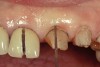 Figure 7   Sulcus depth from the existing attachment to the level of the existing margin is slightly greater than 3 mm. This is a patient who had an altered eruption pattern and a sulcus at the time these restorations were placed of over 3 mm.