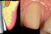 Figure 18   The canine, which still has a deep sulcus, is prepared to the level of the gingival margin prior to placing cord.