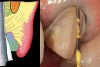 Figure 19  Two layers of cord have now been placed in the sulcus, and a probe is used to ensure they are 1.5 mm apical to the previously prepared margin.