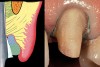 Figure 20  The margin is now extended apically to the top of the cord. Note that by staying within the tooth while preparing the margin, rather than allowing the bur to extend toward the tissue, it has been possible to place the margin 1.5 mm subgingivally, with no bleeding or tissue removal.