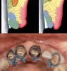 Figure 21  The impression cords have been placed on the incisors and canine. The impression being made is for the construction of an indirect temporary prior to removing the left lateral incisor. By finalizing the margins now, minimal alterations should be necessary after healing. Note the visibility of the cords around all the preparations, except the mesial of the right central incisor. This area can easily be electrosurged to expose the cord. Also note that at this time, the incisors each have 2 cords placed and the canine 3.