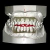 Figure 1  An example of an orthodontic set-up and diagnostic wax-up for a patient with severely worn anterior teeth.