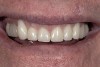 Figure 7  A full-arch temporary was placed to correctly identify an acceptable incisal edge position prior to surgery.