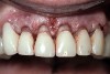 Figure 8  Osseous crown lengthening was performed using the incisal edge position of the temporary to determine bone and gingival levels.