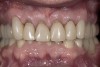 Figure 9  View at 10 weeks post-surgery showing the new gingival level. The preparation and temporary will now be extended to the gingival level.