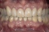 Figure 10  The final restorations demonstrate the esthetic and functional changes from lengthening the incisal edges and raising the gingiva.