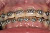 Figure 11  Orthodontics are required to intrude the mandibular anteriors and create space for their build-up.