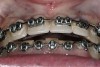 Figure 12  Orthodontics are required to intrude the mandibular anteriors and create space for their build-up.