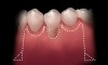 Figure 1  Incisions illustrated with Burrow’s triangles located apical to the mucogingival junction.