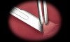 Figure 2  While grasping the tissue at the center of the Burrow’s triangle, a scalpel is used to excise it.
