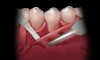 Figure 3  While grasping the flap margin with an Addison forceps, a scalpel is used to create a partial thickness flap.