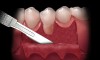 Figure 4  At the mucogingival junction, an incision is made to the underlying bone.