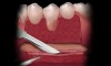 Figure 7  The keratinized collar on the adjacent teeth is denuded and the periosteum at the flap base is scoured with a scalpel.