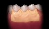 Figure 11  A periodontal dressing is placed to protect the surgical site.