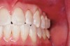 Figure 12  Moderate gingival recession present on the maxillary left cuspid and first premolar.