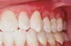 Figure 13  Recession repair on the maxillary cuspid and premolar shown 6 weeks postsurgery.