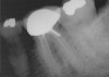 Figure 1  Tooth No. 19 had root canal therapy 8 months before this radiograph. A post was placed in the distobuccal canal. Root canals appeared instrumented and filled several millimeters short of the radiographic apex.