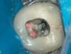 Figure 2  Access was made through the crown and the post in the distolingual canal was isolated conservatively and removed along with the root canal filling material.