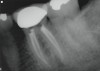 Figure 3  One-month postoperative radiograph. The patient’s symptoms have disappeared completely in the area. The access opening will now be filled definitively.