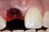 Figure 2  A healing cap was placed after extraction.