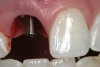 Figure 3  A Straumann 5.5-mm solid abutment was hand-tightened.