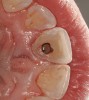 Figure 7  The tooth was tried on the abutment.
