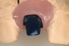 Figure 17  Wax-up of the gold abutment.