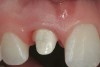 Figure 18  Porcelain-fused-to-metal abutment torqued onto the implant.