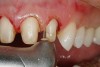 Figure 4  Troughing was performed before tissue displacement to allow access to the submarginal area for the impression medium.