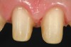 Figure 10  Facial view of the gingival tissues 9 weeks after open-flap surgery and at the time of placement of the ceramic restorations (original magnification 2x). Note the symmetrical positioning of the gingival zeniths of tooth Nos. 8 and 9. The level of tissue health 9 weeks after surgery is excellent.