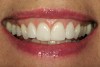 Figure 12  Six months after surgery, the patient‚Äôs full smile showed improvement in gingival symmetry and the gingival papilla between tooth Nos. 8 and 9 had completely reoccupied the gingival embrasure space.