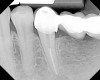 Figure 14  The preoperative radiograph showed an overhanging margin that was in close proximity to the bony crest.